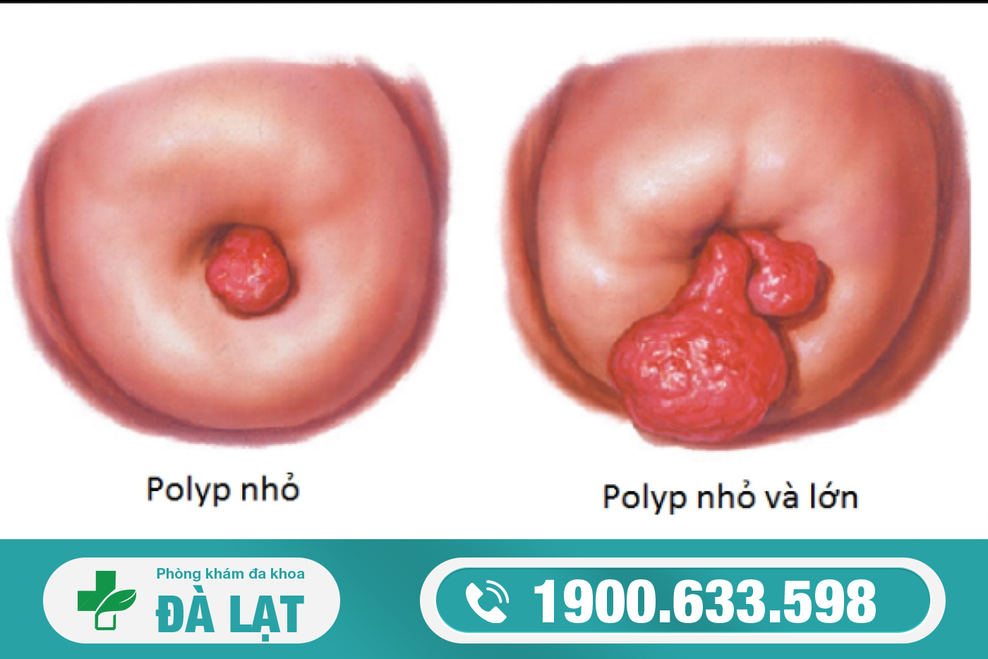 CHI PHÍ ĐIỀU TRỊ POLYP CỔ TỬ CUNG MỚI NHẤT 2025